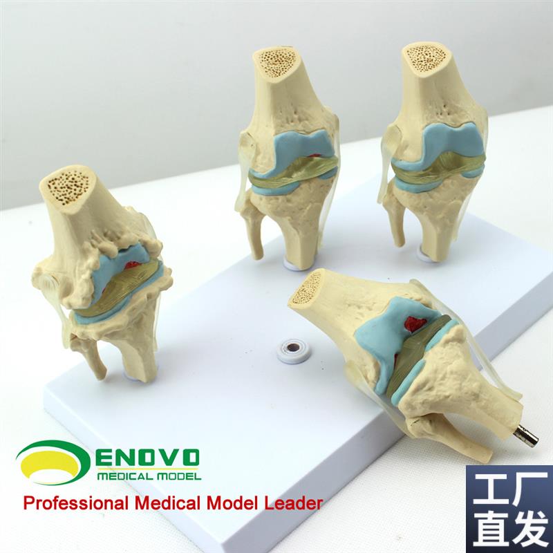颐诺正品人体病理膝关节模型血友病D退行性膝关节病发炎膝关节模