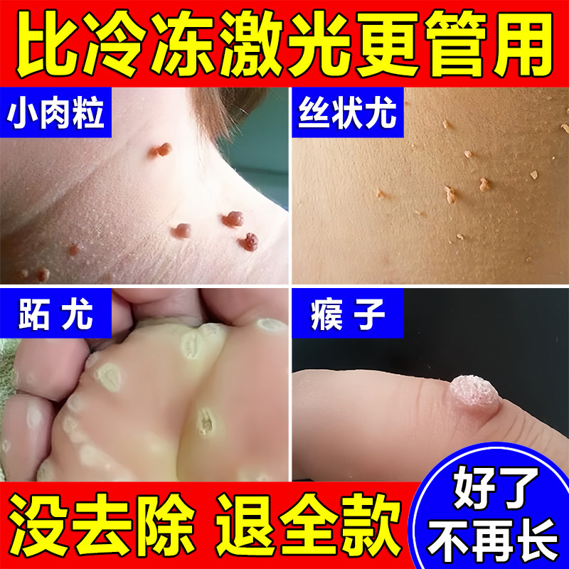 脖子上长小肉粒疙瘩用药专祛扁平丝状神器猴跖疣瘊去除软膏一抹灵