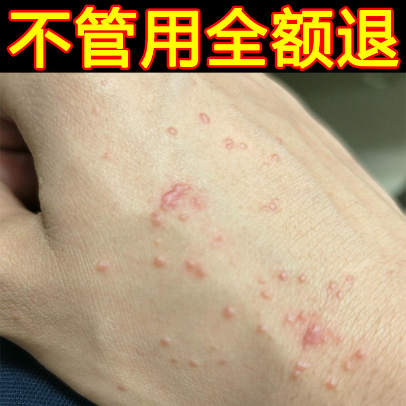 手上长水泡痒汗疹膏手指上起水泡脱皮干裂手痒小水泡皮肤过敏水泡