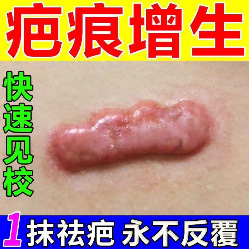 疤痕灵疙瘩胸前增生凹凸起软化修复膏去除去伤疤痕贴耳洞刀疤药膏