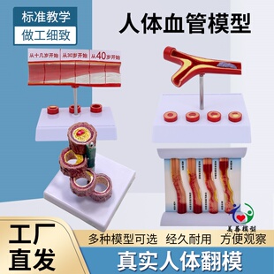 教学仿真人体病理血管堵塞动支脉粥样硬化心血管动态动脉血栓模型