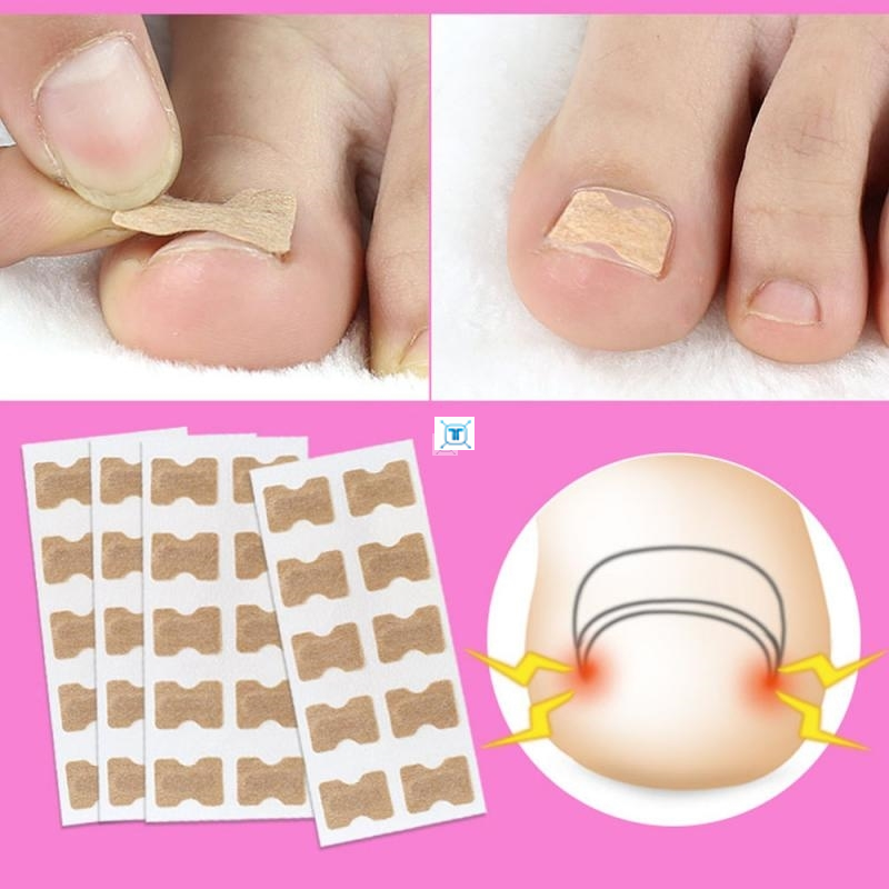 10/20PCS Ingrown Toenail Correction Stickers Glue Free Ing