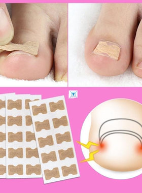 10/20PCS Ingrown Toenail Correction Stickers Glue Free Ing