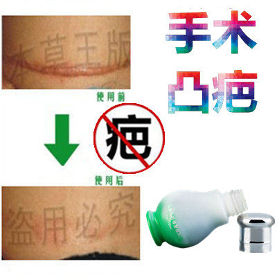 祛手术烟烫增生性突起疙瘩破腹产刀伤巴痕烟疤缝针抓伤摔伤双眼皮