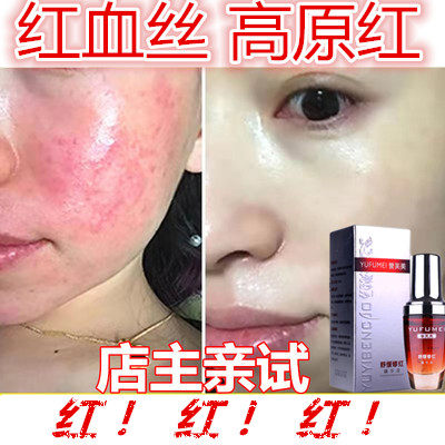 修复过敏苹果脸发红发烫发痒改善敏感性皮肤增厚角质层祛除红血丝