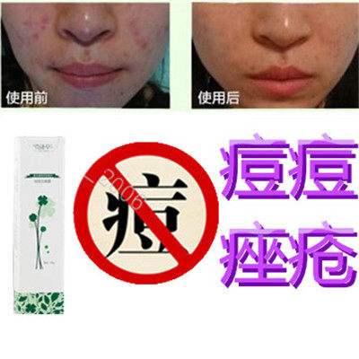 正品祛除胸前黑头痘痕平暗疮后背部封闭合性酒刺痤疮青春痘痘豆豆
