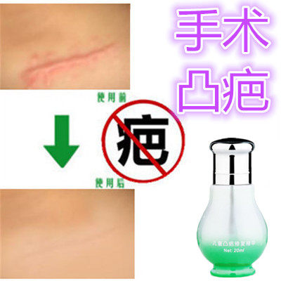 灵手术烟烫增生性突疤疙瘩破宫产刀伤巴痕烟疤缝针抓伤摔伤双眼皮