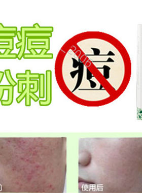 封闭合性白头痘痕立消除去前胸痤疮平霜祛后背豆豆酒渣鼻油脂粒液