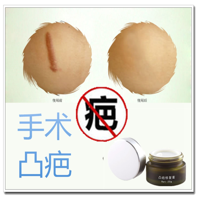 剖腹产后防疤修复膏去脸部伤疤痕灵的药除痣灵正品淡化黑色素克星