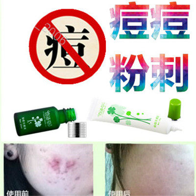 正品面疮酒刺霜祛后背部痤疮粉刺立消青春痘痘克清除去胸前豆豆液