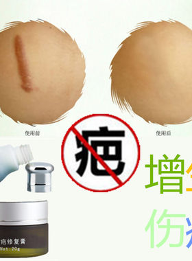 除去疙瘩增生性突起祛缝针剖宫产刀伤疤痕纹身手术摔伤色素印药膏