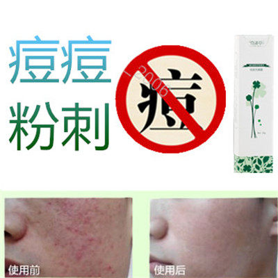 植物祛封闭合性青春痘痘消除男女面疮酒刺去胸前后背上豆豆痤疮霜