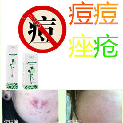 去额头油性粉刺清除后背暗疮痤疮膏正品修复液青春痘祛闭合性豆豆