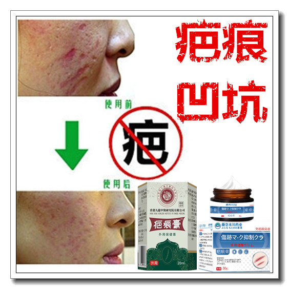 去除烟烫增生性体质祛手术凸疤剖腹产伤疤痕印灵疙瘩纹身沉着色素