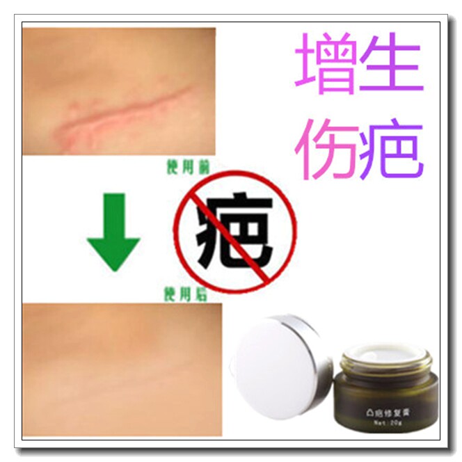 去除胸前凸起祛脸部缝针疤痕灵疙瘩软化增生克星修复膏贴防止留疤