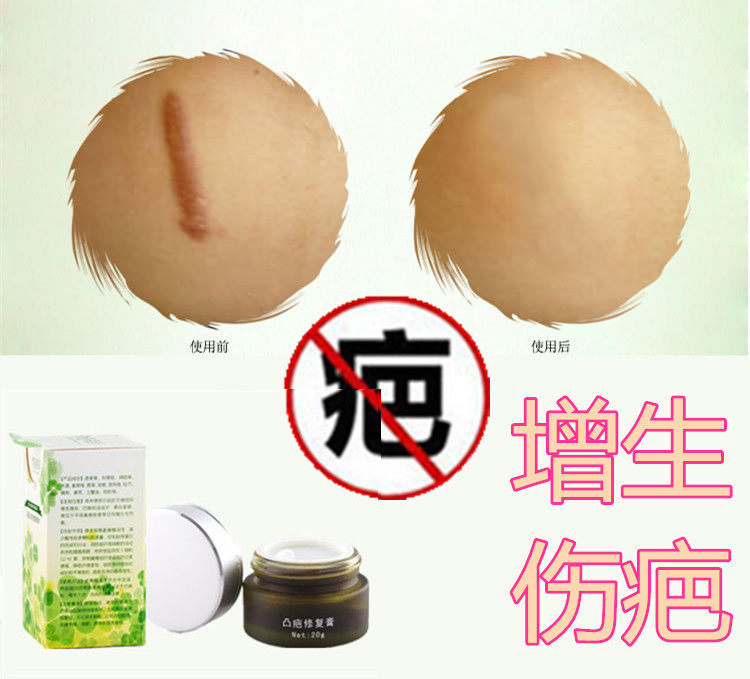 软化增生性疙瘩祛除凸起剖腹产缝针疤痕印去手术后摔伤药液修复膏