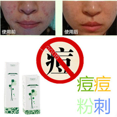 正品暗疮痘疤痕祛除封闭合性背上痘痘立消无痕霜粉刺印脂肪粒痤疮