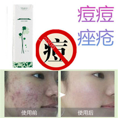 修复舒缓防敏感豆痘印去除额头黑头痘疤痕精华霜祛后背部豆豆色素