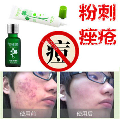 产品药用去后背部豆豆膏胸前封闭合性痘痘立消除祛液痤疮印粉刺平