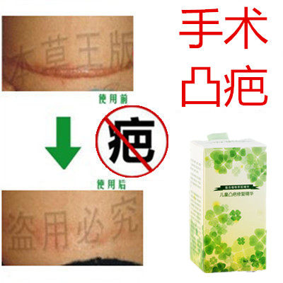 除缝针烟烫剖宫产突疤疙瘩破腹产刀伤巴痕烟疤手术抓伤摔伤双眼皮