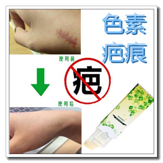 腋下祛黑神器去退黑色素脸部白印修复膏双眼皮疤痕增生防水贴洗澡