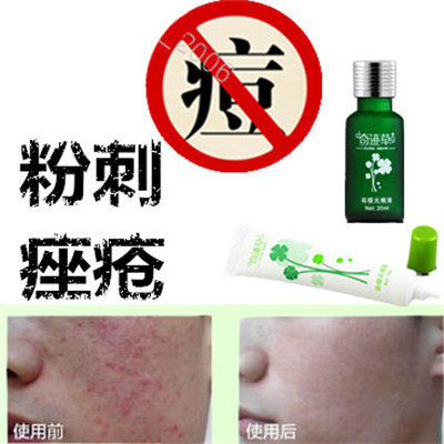 正品面疮酒刺去后背部痤疮平青春痘痘全清祛除胸前封闭合性豆印液