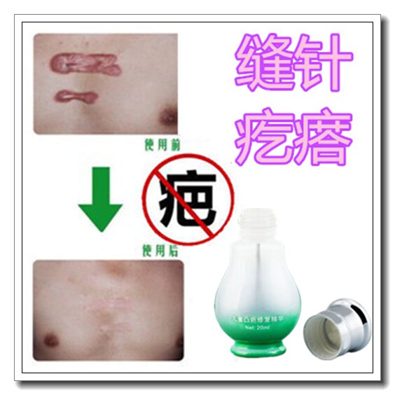 祛除脸部烟疤易消正品去色沉黑色素手术剖腹产后增生贴疤痕平软膏