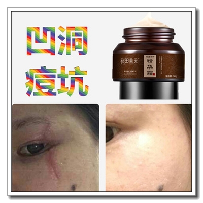 祛除凹陷痘疤痕灵快速淡化凹坑去痘坑修复凹洞生长膏芦荟胶霜产品