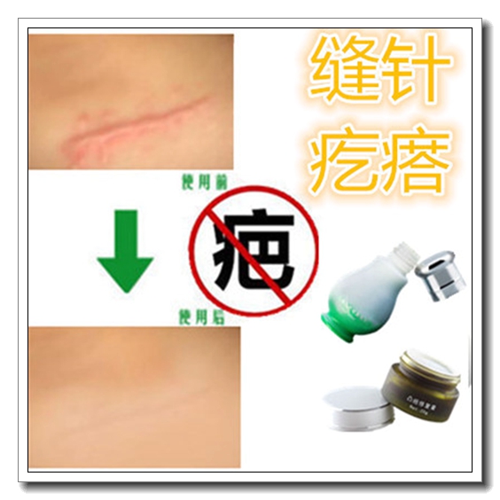 祛烧烫伤疤痕颈部脖子黑色素沉淀红印药去除剖宫产增生凸起修复贴