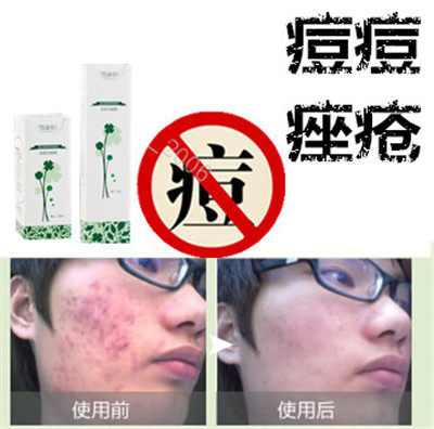 奇迹草本药用产品封闭合性青春豆痘立消疤痕脂肪粒豆印祛除痤疮液