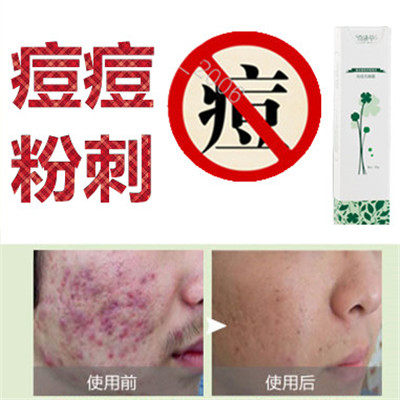 正品除去男女面部前胸后背额头痘痘痘痕青春痘修复痤疮酒糟鼻产品