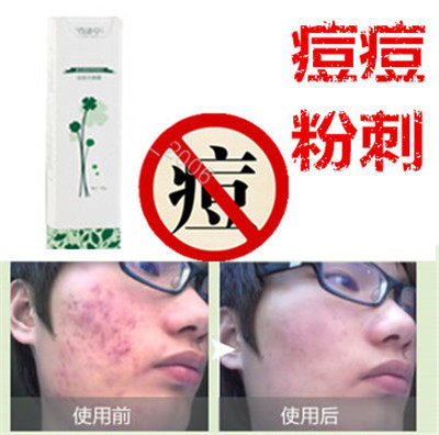 去后背部酒刺封闭合性痘痘痘痕酒糟鼻舒缓防敏感除祛前胸痤疮精华