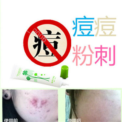产品药用除祛男女面部青春痘痘痕修复前胸额头痘痘背部豆豆酒糟鼻