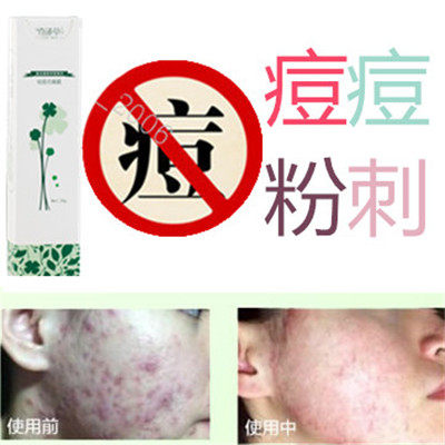 奇迹草本去前胸封闭合性酒刺青春痘痘祛除后背白头痤疮脂肪粒痘痕