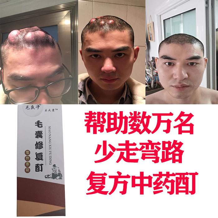 毛囊炎头上脸上后背长痘痘头痒有疙瘩头部头皮毛囊炎喷剂