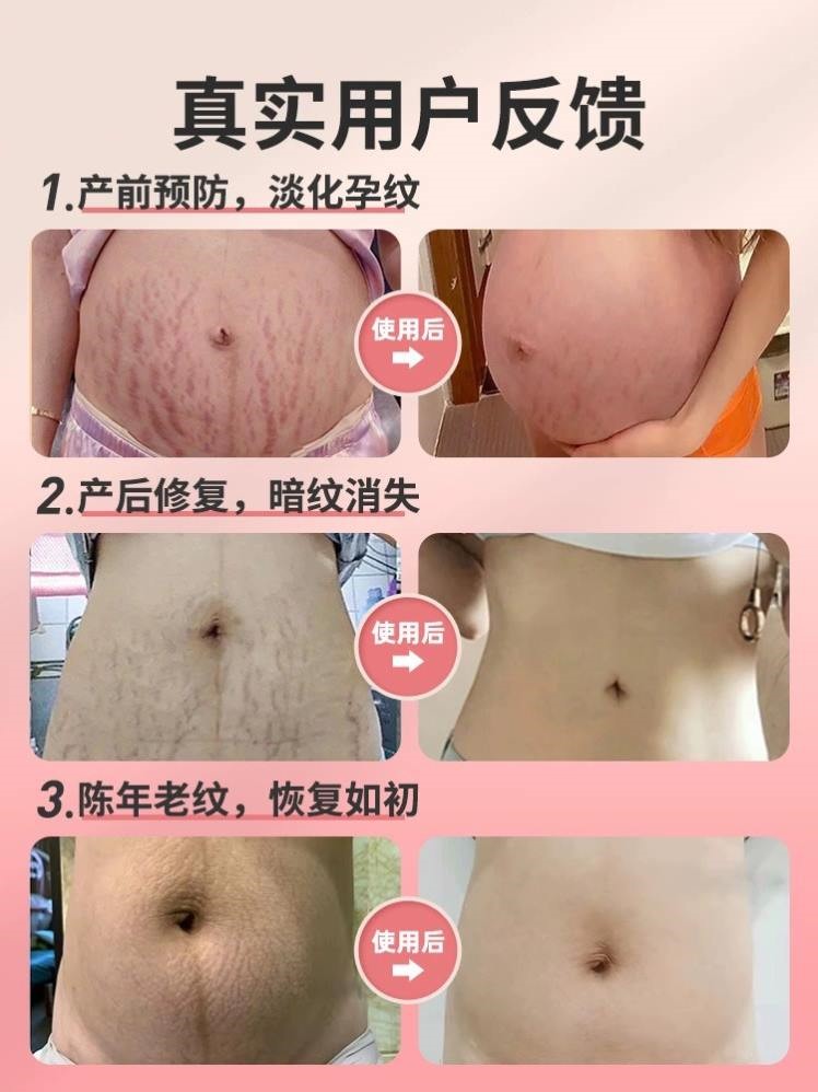 妊辰纹消除去妊娠纹紧致肚皮预防孕妇专用皮肤提拉紧致疤痕除疤膏