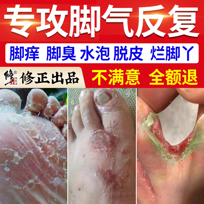 修正止痒杀菌脱皮烂脚丫专攻脚气