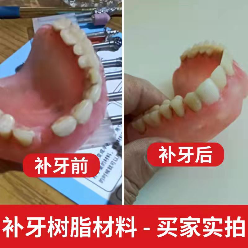 缺牙临时假牙补牙齿牙缝隙填充神器自补树脂材料单颗门牙套牙仿真