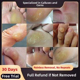 老茧去除软化剂泉百年草本植物祛脚钉膏去小脚趾头磨出茧子根神器