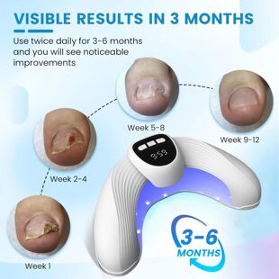 atment Laser Fungal Infection Repair Anti Device Nail