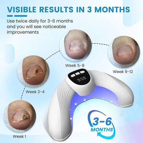 Nail Fungal Laser atment Device Repair Anti Infection