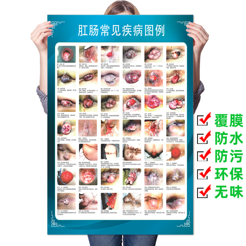 肛肠常见痔疮疾病图例墙贴纸肛肠科医院贴纸挂图宣传海报装饰画