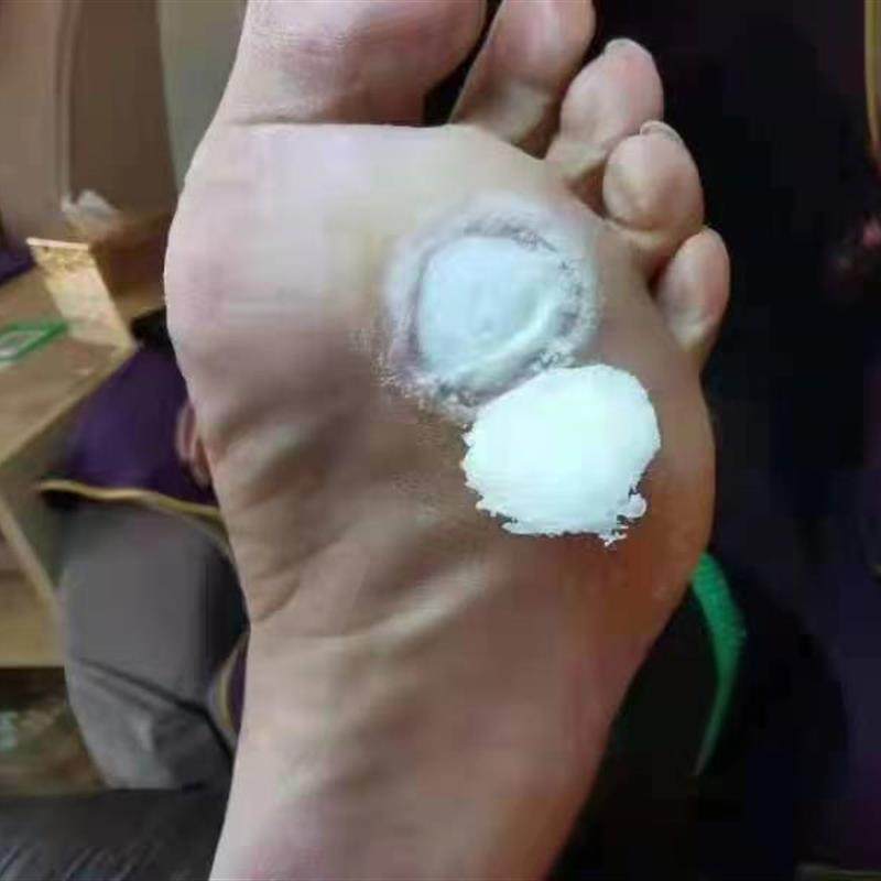 茧无霸 去除老茧脚垫脚钉角质层增厚持久修护买2送1买3送2买5送3,保健用品,皮肤消毒护理（消）,淘宝优惠券,粉丝福利购,淘宝优惠卷