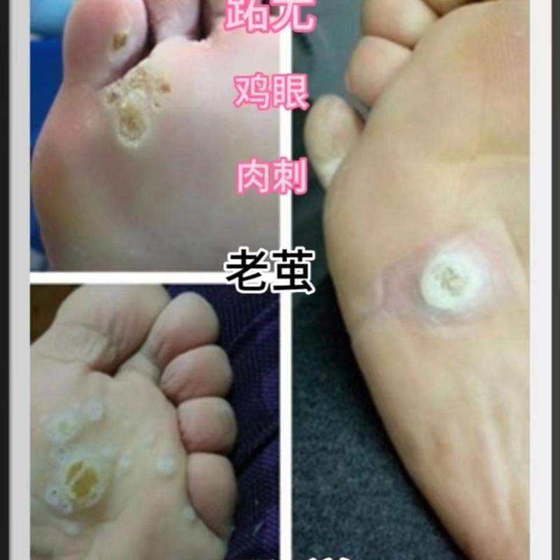 止尤液鸡眼跖尤丝状尤肉刺老茧血包刺买3盒送1买6盒送3盒送同款五,保健用品,皮肤消毒护理（消）,淘宝优惠券,粉丝福利购,淘宝优惠卷