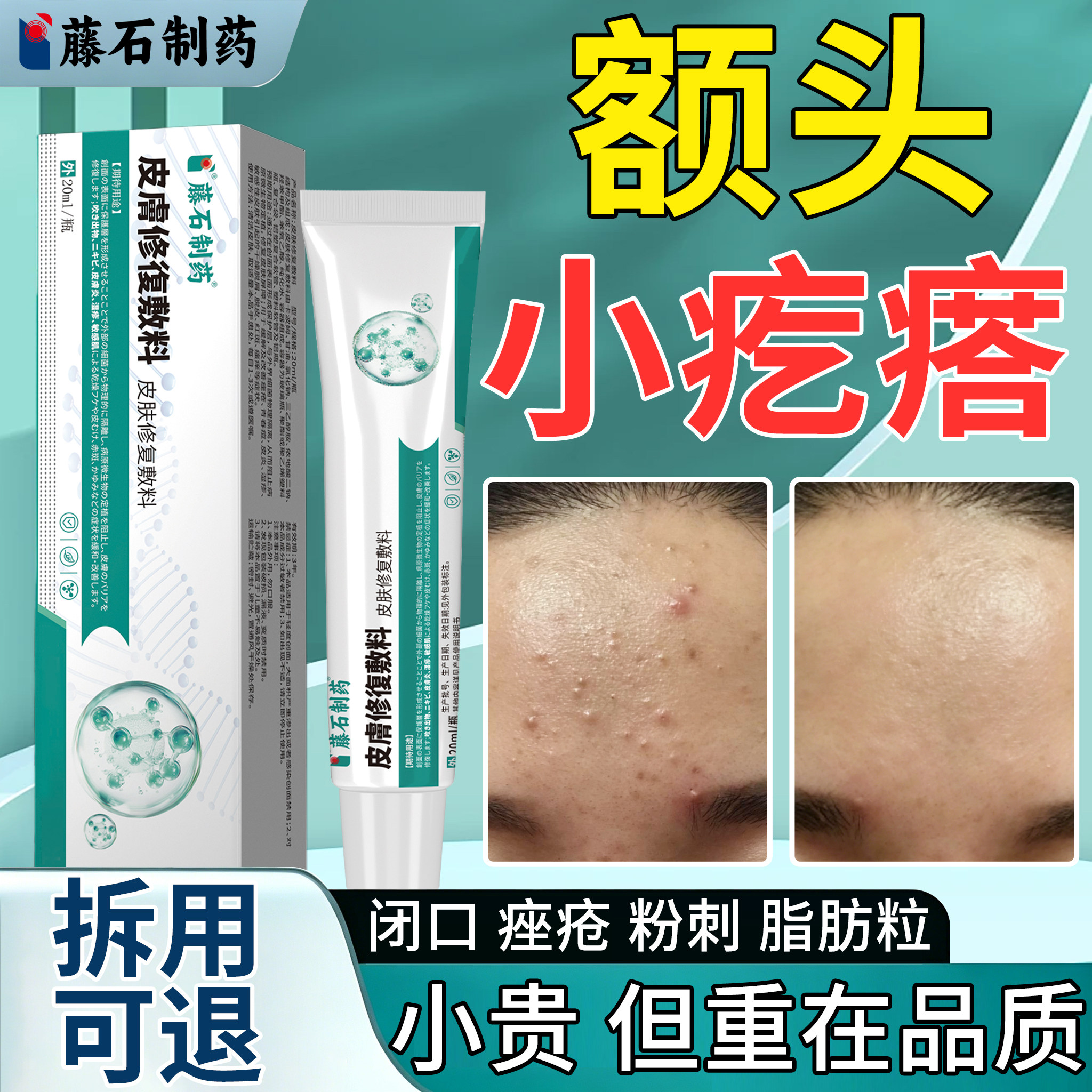 额头上长痘痘闭口长痘小疙瘩密密麻麻小白点脂肪粒粉刺SY