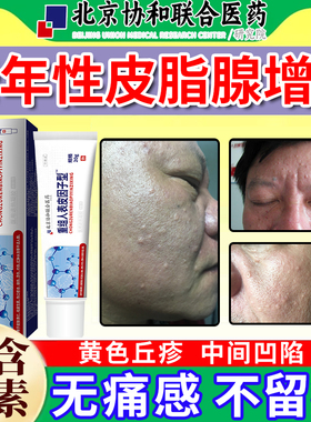 皮脂腺增生增大囊肿黄色丘疹额头脸部男老年性凹陷小疙瘩异位症YU
