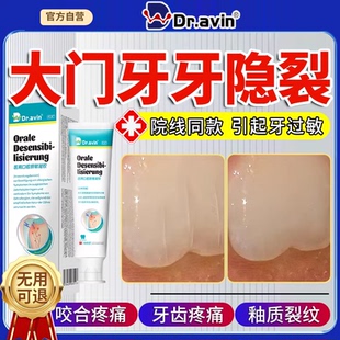 牙隐裂龈裂牙齿表面裂纹修复含氟可搭牙膏牙釉质牙齿咬合痛出血LJ