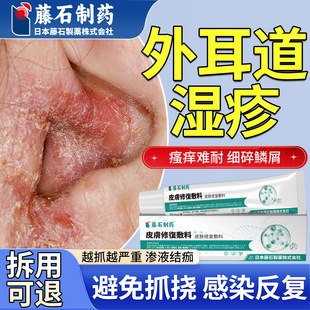 外耳道炎耳朵湿疹耳朵痒真菌感染发炎中耳炎流脓止痒药房同款膏SY
