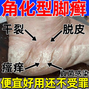 角化型脚气湿疹足癣一次脚净底干裂脱皮鳞屑脚癣膏后跟真菌感染YU