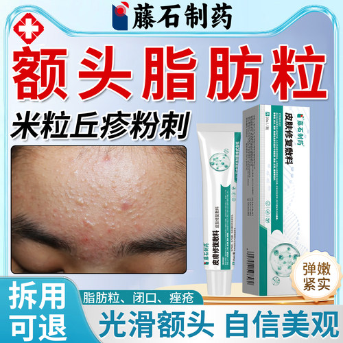 额头脂肪粒脸上长痘痘闭口粉刺